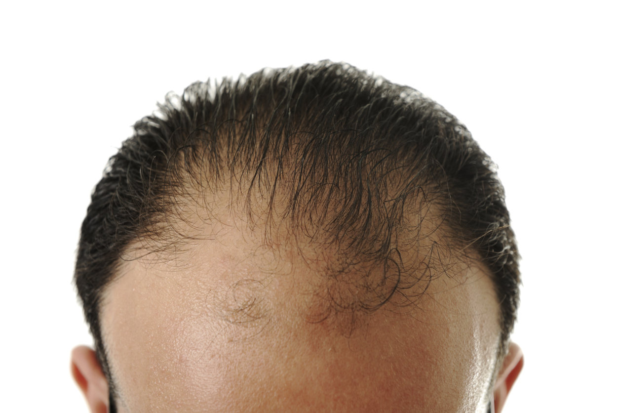 Hair Loss Prevention